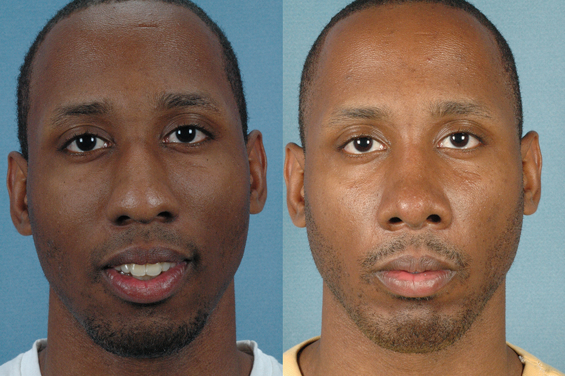 LOWER FACE - Chin implant with septorhinoplasty - Male before and after photos photo