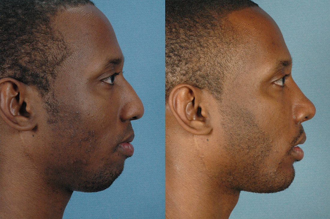 LOWER FACE - Chin implant with septorhinoplasty - Male before and after photos photo