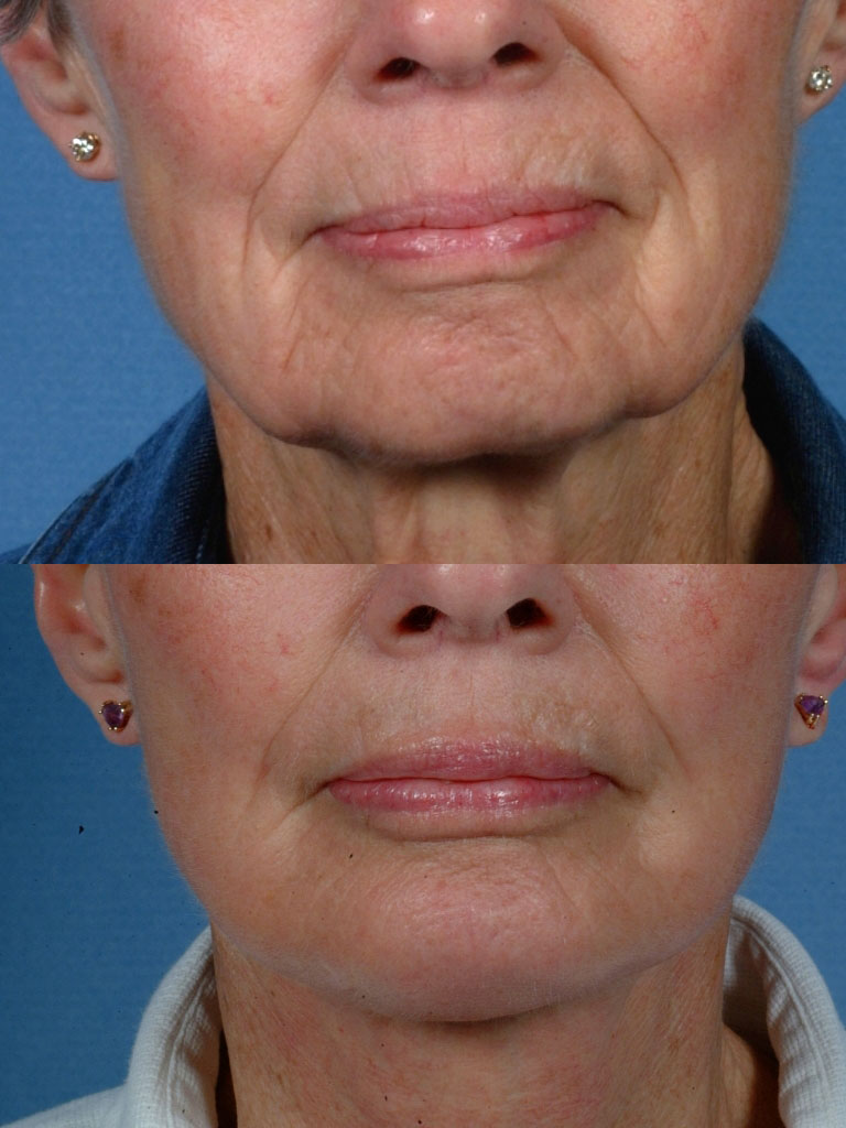 LOWER FACE - Jaw and necklift (facelift) with chin implant - Before and After Photos: Female (frontal view)