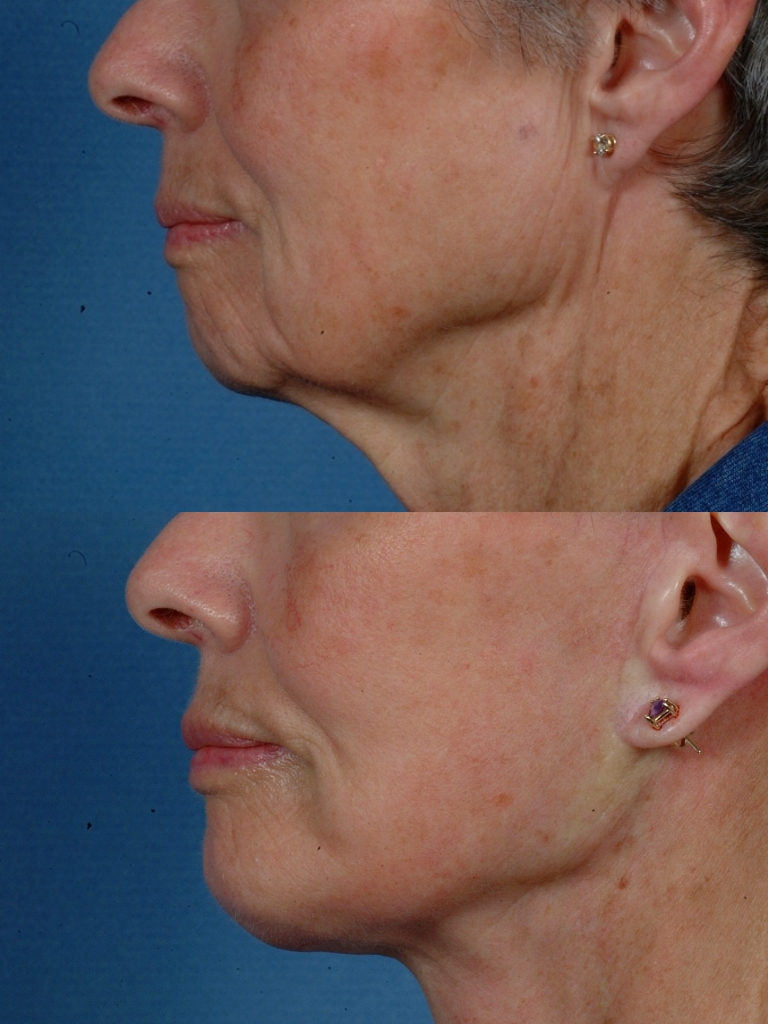 LOWER FACE - Jaw and necklift (facelift) with chin implant - Before and After Photos: Female (Left side view)