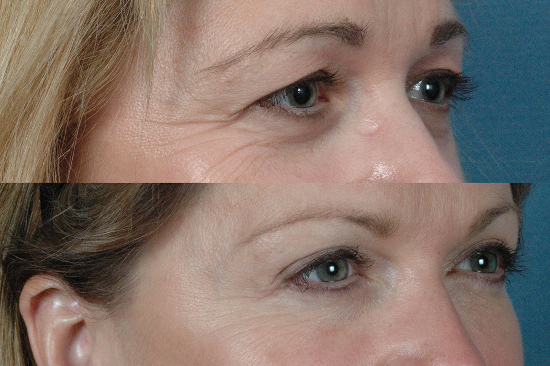 Eyes - Upper and Lower Blepharoplasty - Before and After Photos: Female (right side, oblique view)