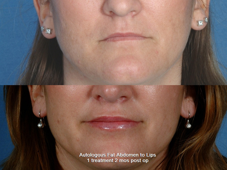 MOUTH AND LIPS | Photos: Before and After Treatment - Woman (frontal view)
