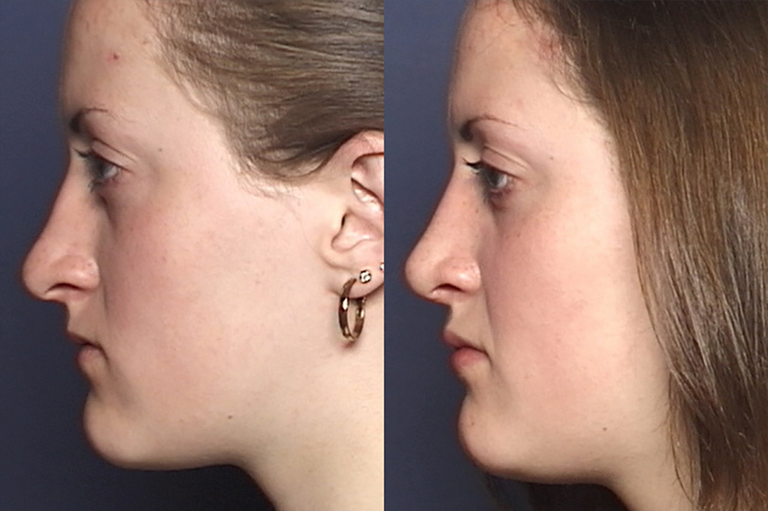 NOSE |Septorhinoplasty| Before and After treatment - Photo: Female patient (left side, oblique view)
