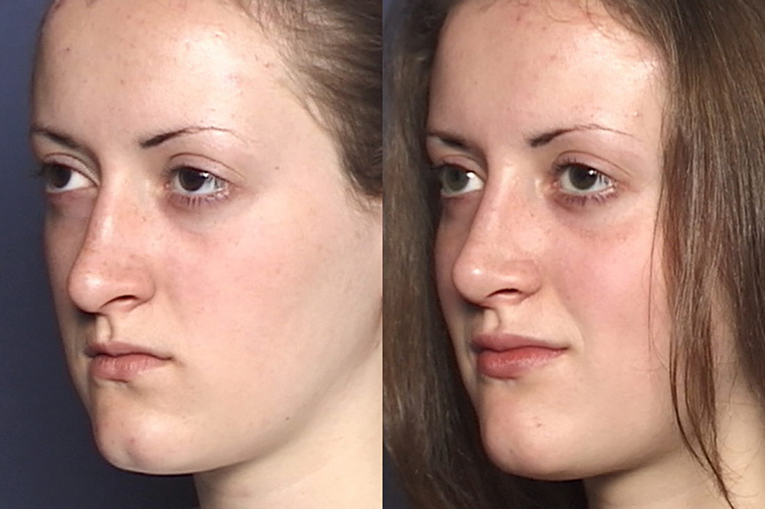 NOSE |Septorhinoplasty| Before and After treatment - Photo: Female patient (left side, oblique view)