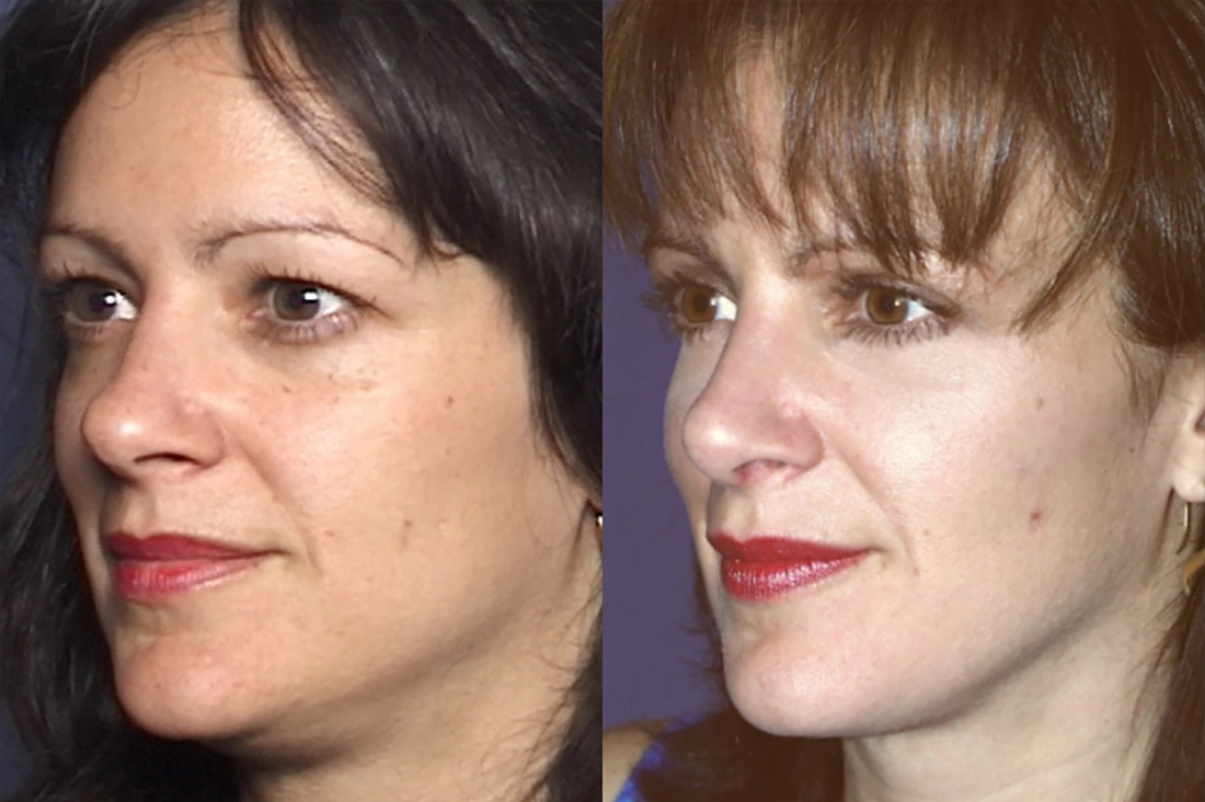 GALLERY Lower Face: Liposculpture - Before and After Treatment Photos - Female patient (right side, oblique view)