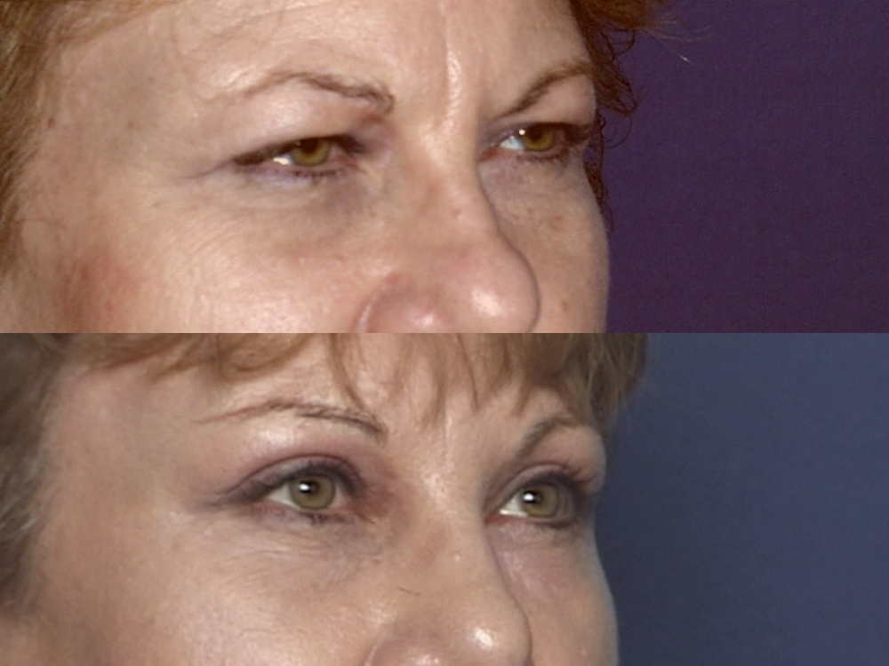 PROCEDURES: Forehead and Eyebrow - Before and After Photos: Female Patient (obliPROCEDURES: Forehead and Eyebrow - Before and After Photos: Female Patient (oblique view)