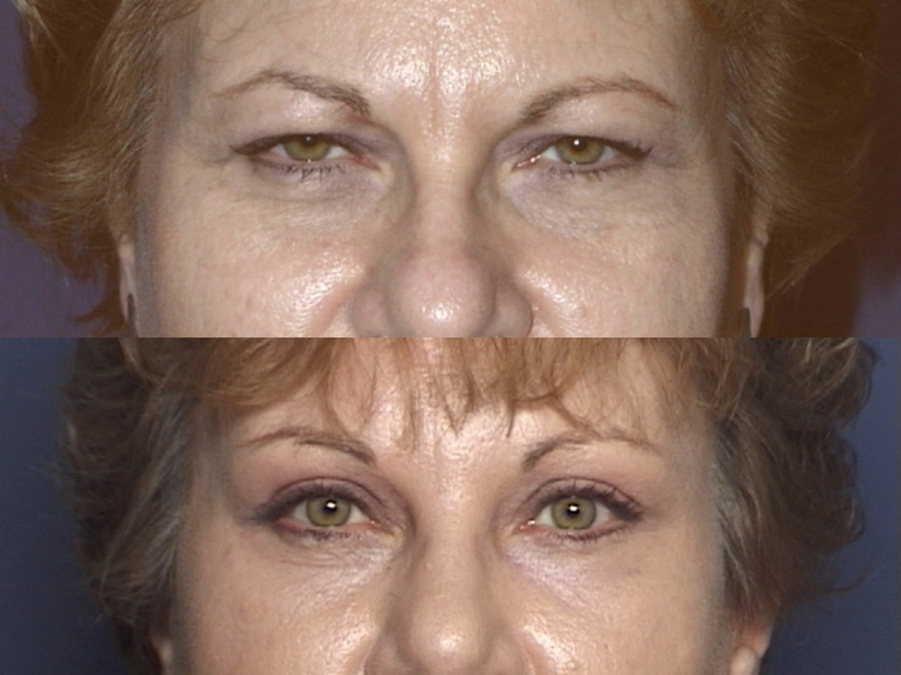PROCEDURES: Forehead and Eyebrow - Before and After Photos: Female Patient (obliPROCEDURES: Forehead and Eyebrow - Before and After Photos: Female Patient (oblique view)