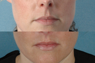 PROCEDURES: Forehead and Eyebrow - Before and After Photos: Female Patient (oblique view)