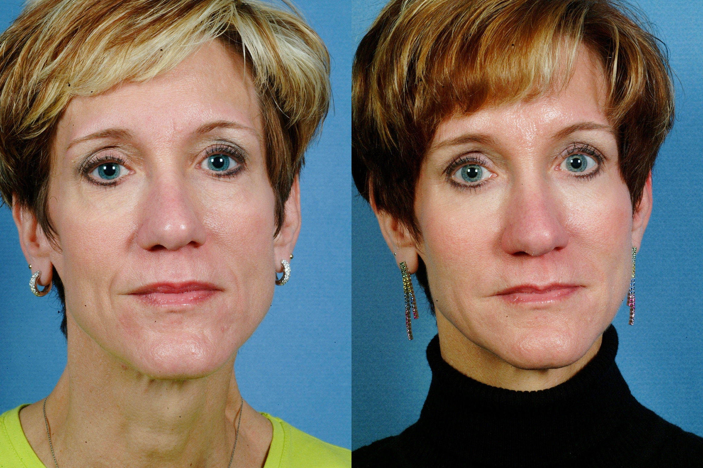 MIDDLE FACE | Before and After Treatment - Photos: Female (frontal view)