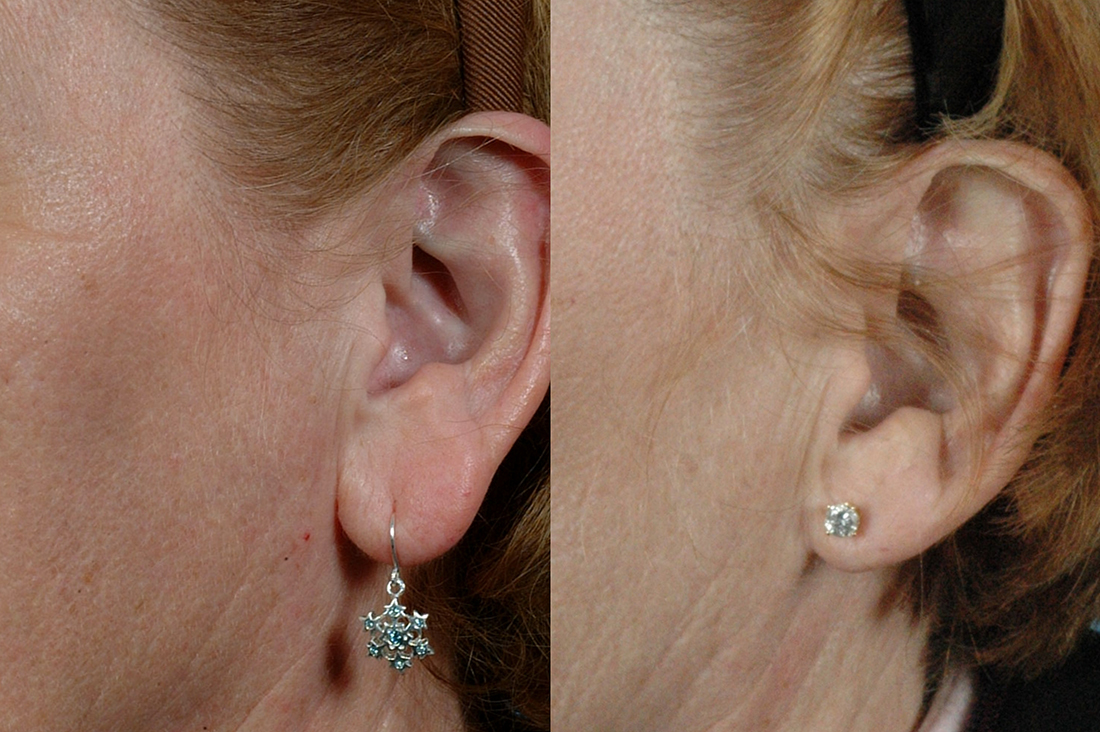 Ear Lobe Reduction - Before And After Treatment - Female (left side, oblique view)
