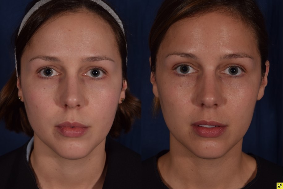 Woman patient before and after photo