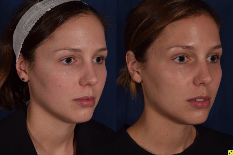 Woman patient before and after left photo