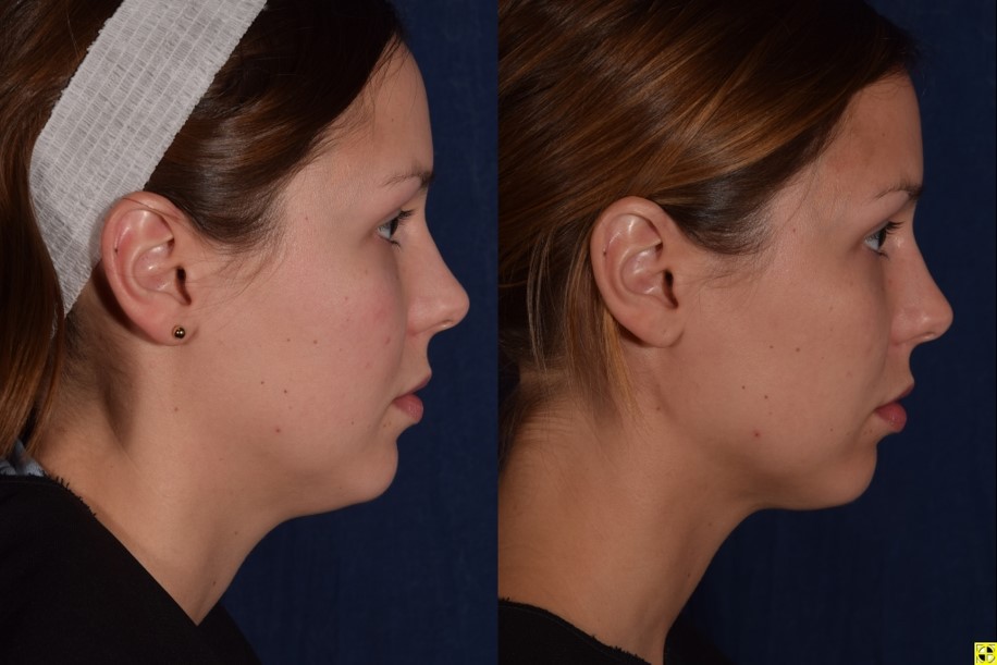 Woman patient before and after front photo