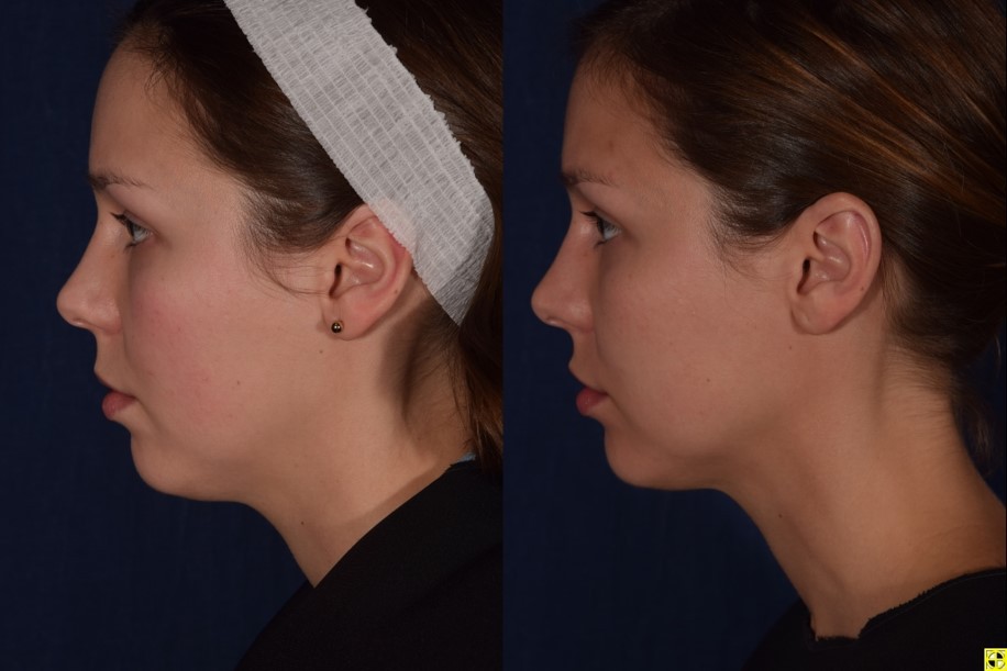 oman patient before and after right side photo