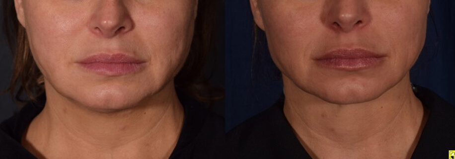woman patient left side photo