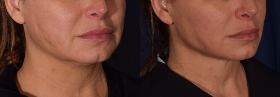 woman patient left side photo