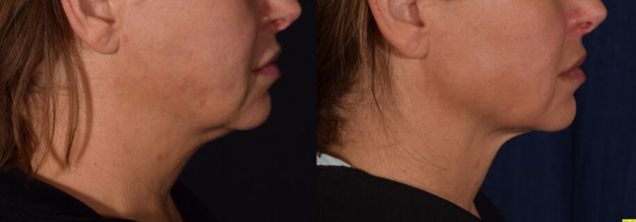 woman patient front photo