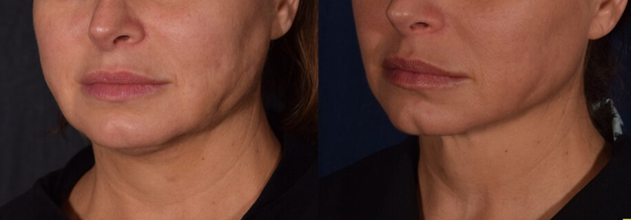 woman patient right side photo