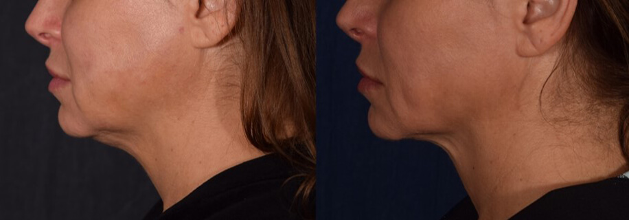 woman patient right side photo