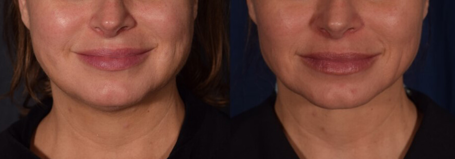 woman patient right side photo