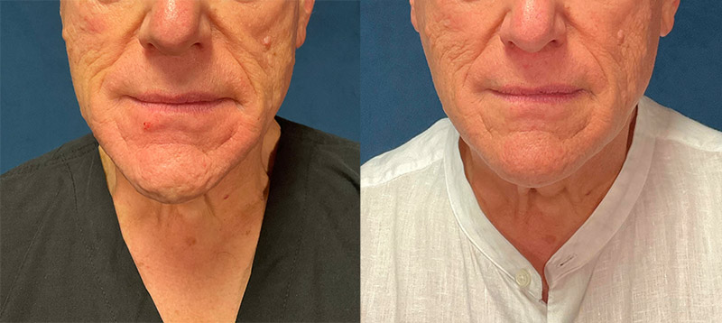 Neck lift woman patient right side photo