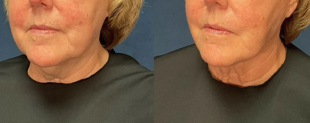 Woman patient before and after photo