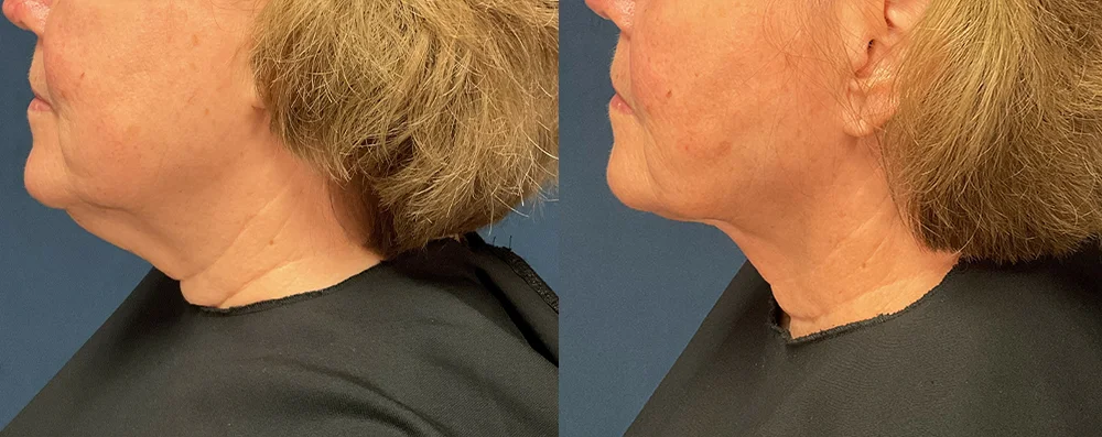 Woman patient before and after left photo