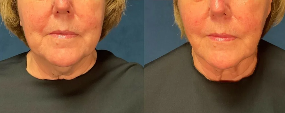 Woman patient before and after front photo