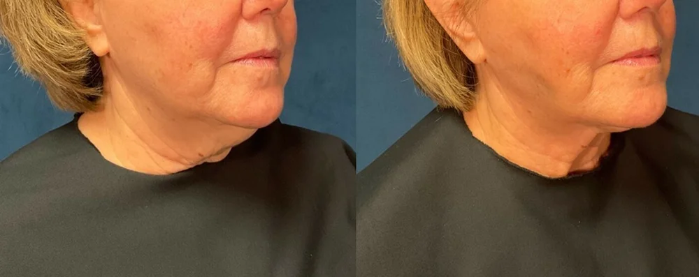 Woman patient before and after right side photo