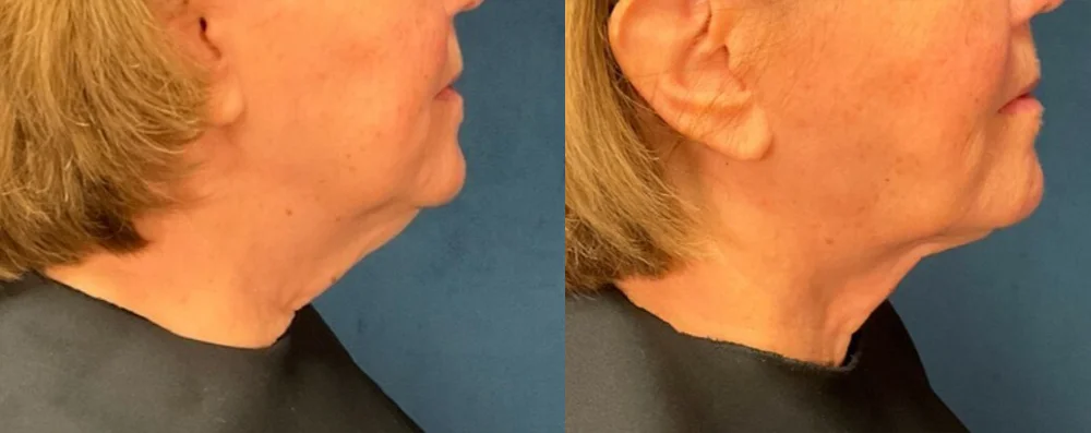 oman patient before and after right side photo